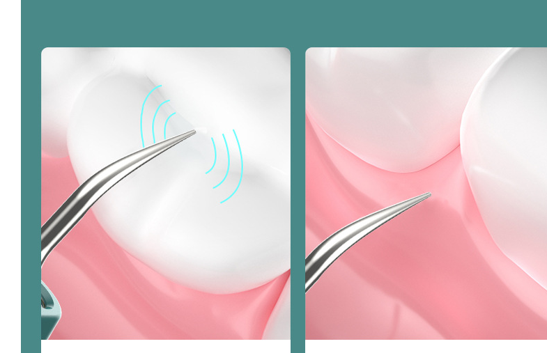 pulizia dentale con camera